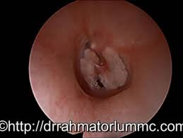 Image result for Myringosclerosis