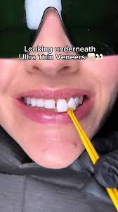 Exploring Ultra Thin Veneers: A Close Look at Dental Enhancements