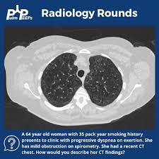 Image result for Emphysema