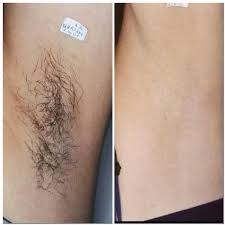 Get A Laser Hair Removal Over Tattoo