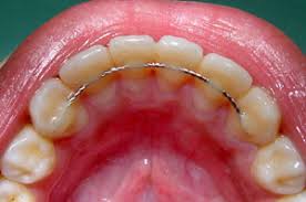 Nov 06, 2020 · the exact length depends on your orthodontist or dentist's recommendation. I Ve Always Worn My Clear Nighttime Retainers Religiously Can I Get My Permanent Metal Retainers Taken Out Medical Sciences Stack Exchange