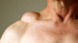 These hard lumps, which develop under the skin, may persist for years, enlarge and become inflamed. What Is A Skin Lump Symptoms Causes Diagnosis Treatment And Prevention Everyday Health