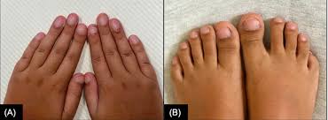 Image result for Protein C Deficiency