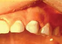 Preventing Early Childhood Dental Decay