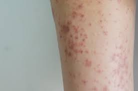 Image result for chickenpox