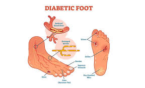 However, at some point the callus can get so thick than it can. Impact Of Corns Calluses On Diabetics And How To Treat Them Medlife Blog Health And Wellness Tips