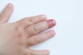 Paronychia Causes And Treatment Of An Infected Nail Maybe yours are growing sideways, thick and yellow, or falling off.