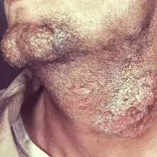 Image result for Beard Dermatitis