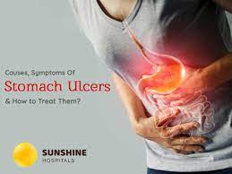 The most common peptic ulcer symptom is burning stomach pain. Causes And Symptoms Of Stomach Ulcers How To Treat Them Best Hospital In Hyderabad