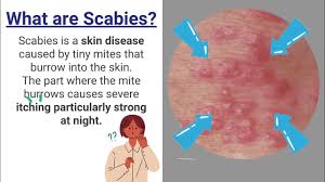 Image result for scabies transmission