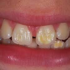 Pdf Hypoplastic Enamel Treatment In Permanent Anterior Teeth Of A Child