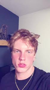 @Tyler ignore pimple patch 😘#onedirection