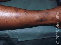 Image result for flea bites