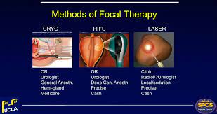 Focal Therapy Of Prostate Cancer Partial Gland Ablation