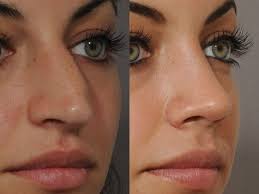 Rinoplastia Rhinoplasty Cost Nose Surgery Nose Job