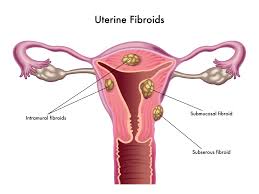 This article goes over symptoms, causes & solutions. Uterine Fibroids Npc