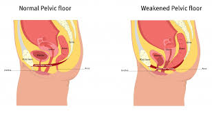 Image result for Pelvic Floor Dysfunction