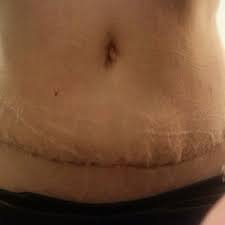 Coconut water helps restore energy and maintains the optimal balance of fluid in the body. The Bottom Of My Tummy Is Like A Waterbed After A Tummy Tuck Do I Have A Seroma Photo