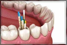 MANFAAT DENTAL GUTTA PERCHA | Syaf Unica Indonesia