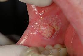 Human papillomavirus (hpv) is a common sexually transmitted infection. Hpv And Oral Cancer What S Your Risk Soundbridge Dental Arts Sleep Therapy