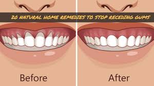 Check spelling or type a new query. 20 Natural Home Remedies To Stop Receding Gums