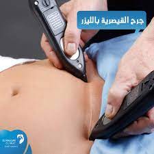 جرح القيصرية بالليزر د محمود النجار للنساء والتوليد facebook