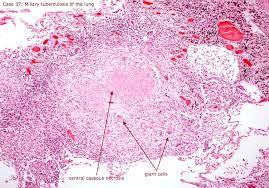 Death of cell tissues 2. Necrosis Pathology Medbullets Step 1