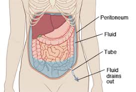 At this point, a liver transplant is necessary. Paracentesis Saint Luke S Health System