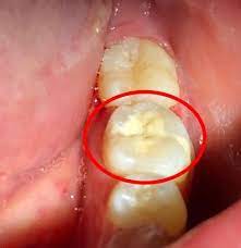 Glass Ionomer Or Composite Filling For Children Pediatric Dentistry Composite Fillings Filling