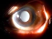 Image result for iol implant might be treatment for clouding of the lens, which is also known as: