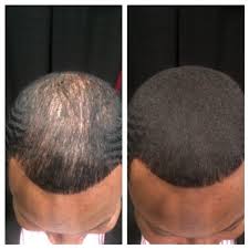 If the hair loss genes activate earlier in life — for example, when a man is in his 20s — the rate of progressive miniaturization and hair loss will be highly accelerated when compared. How To Fix A Bald Spot Or Lack Of Hair Tips For Men Thyblackman Com
