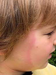 Erythema Migrans Wikipedia