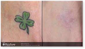 Best tattoo removal in fayetteville, nc. The Laser Institute Of Pinehurst Offers Tattoo Removal With The Picosure Laser