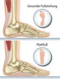 Knick Senkfuss Knick Plattfuss Schwache Der Tibialis Posterior Sehne Gelenk Klinik De