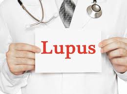 Può coinvolgere altri organi determinando: Lupus I 15 Sintomi Poco Conosciuti Che Non Vanno Ignorati Corriere It
