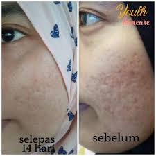 Testimoni Hilangkan Parut Jerawat Dengan Youth Skincare