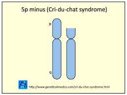 Cri Du Chat Syndrome Cri Du Chat Cri Du Chat Syndrome Syndrome