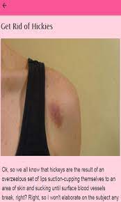 However long it takes for skin to soften. How To Get Rid Of Hickeys Amazon De Apps Spiele