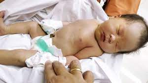 Kondisi ini biasanya terjadi akibat bayi selalu mengalami muntah kuning dan terkadang juga mengeluarkan muntah hijau. Pengalaman Pribadi Saya Menangani Bayi Kuning Kumparan Com
