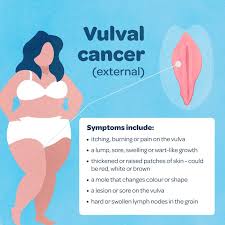 What Is Gynaecological Cancer And What Are The Symptoms Queensland Health