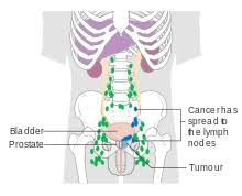 Cancer can develop in lymph nodes either by originating there (as a primary tumor) or by spreading from a tumor somewhere else in the body (metastasis). Prostate Cancer Wikipedia