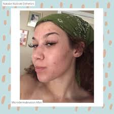 ✨What is Microdermabrasion✨, •, Microdermabrasion is an amazing way to  exfoliate your skin if you are sensitive to chemical forms of exfoliants.  Not only does it smooth the skin, but it also helps ...