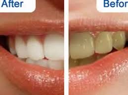 I've been using the crest whitestrips intense professional, do i need to stay on a 'white diet' for a full 7 days as this is proving hard to do! Crest Supreme Whitestrips Before And After Results Video Dailymotion