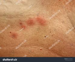 Mosquito Bites On Skin Under Breast Stock Photo 1831982848 | Shutterstock
