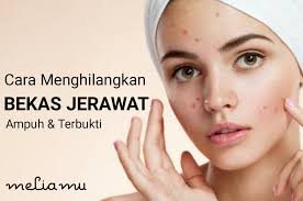 10 Cara Menghilangkan Bekas Jerawat Secara Alami Dalam 1 Hari Jerawat Produk Jerawat Perawatan Rambut Alami