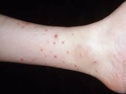 Image result for flea bite