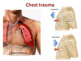 Image result for Chest Trauma