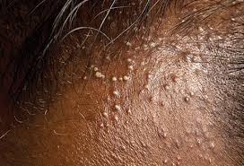 scalp inflammation treatment atlanta