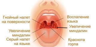 Gnojnaya Angina U Rebenka I Vzroslogo Prichiny Vozniknoveniya I Formy Patologii Metody Diagnostiki I Klinicheskie Simptomy Lechenie Medikamentami I Narodnymi Sredstvami