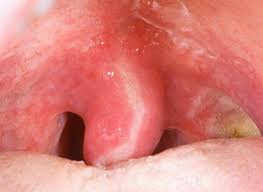 Nonetheless, below are the reasons why you get uvulitis in your throat. Swollen Uvula Causes Symptoms Treatment Surgery And Remedies 2020 Updated